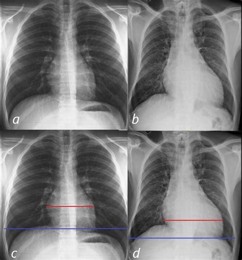 lv enlargement cxr|normal left ventricular enlargement.